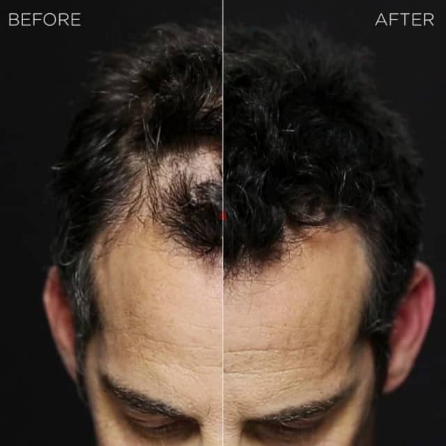 Toppik Hair Filler 3-in-1 for Thinning Hair and Receding Hairline 2