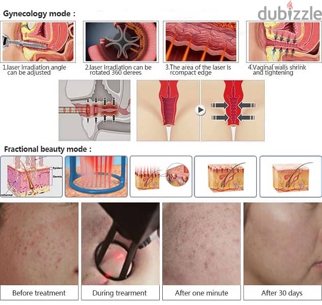 co2 fractional laser 3