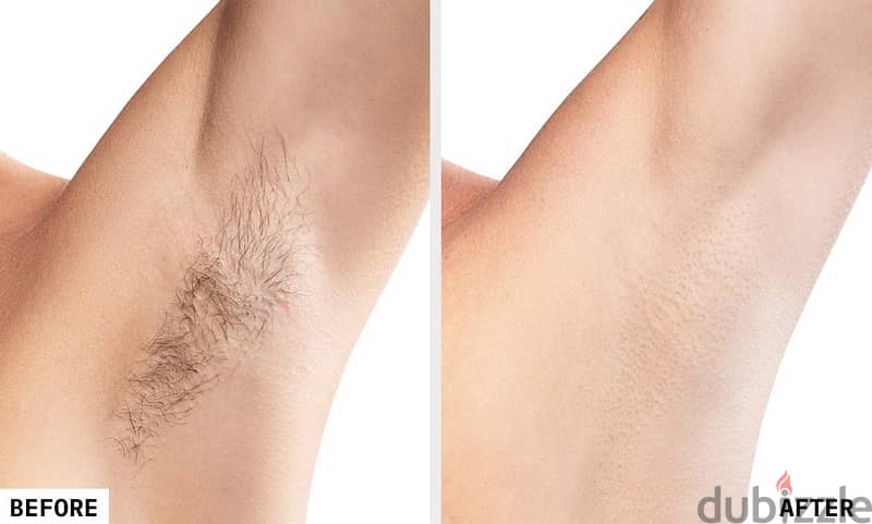 laser hair removal 1