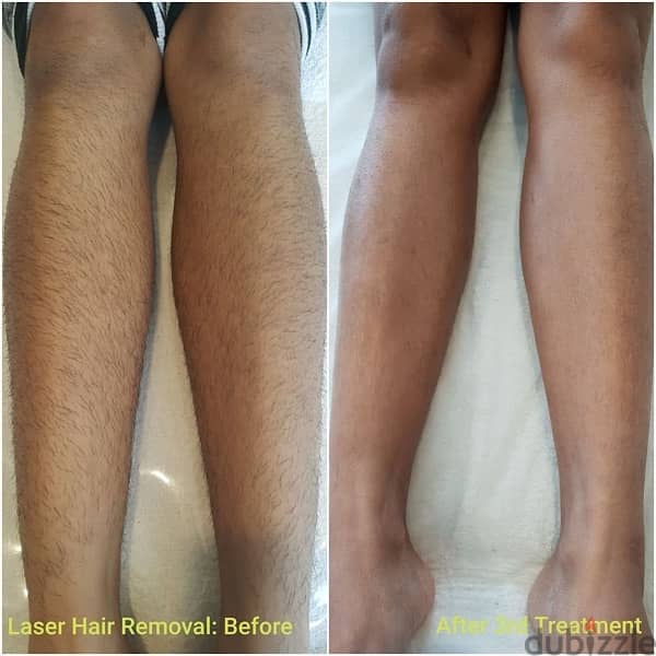 laser hair removal 2