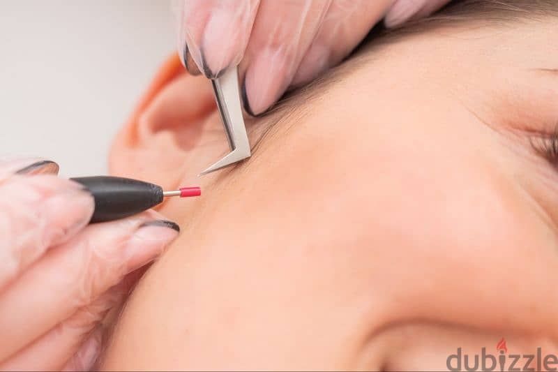 Electrolysis hair removal 0