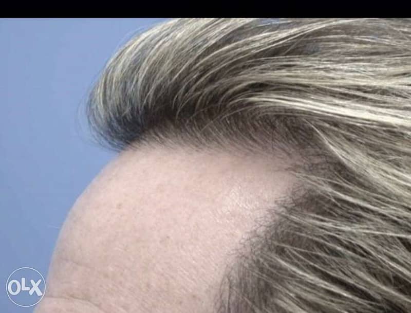 hair replacement for men 2