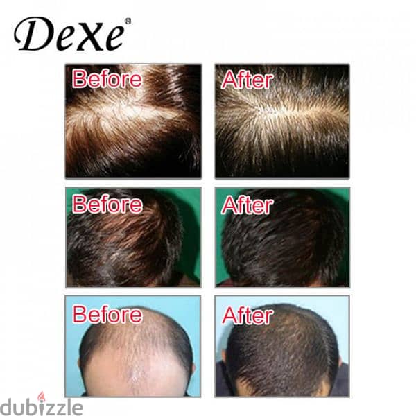 Dexe Anti Hair Loss 3